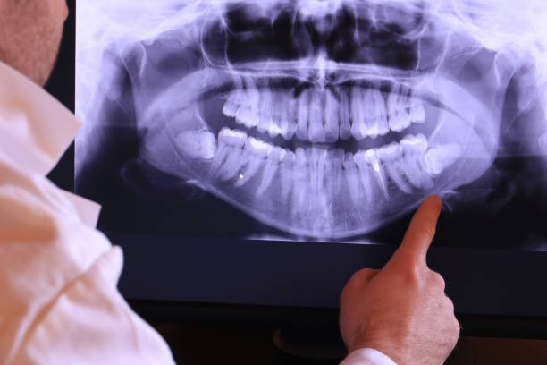 Best Emergency Tooth Extraction in Kaysville, UT